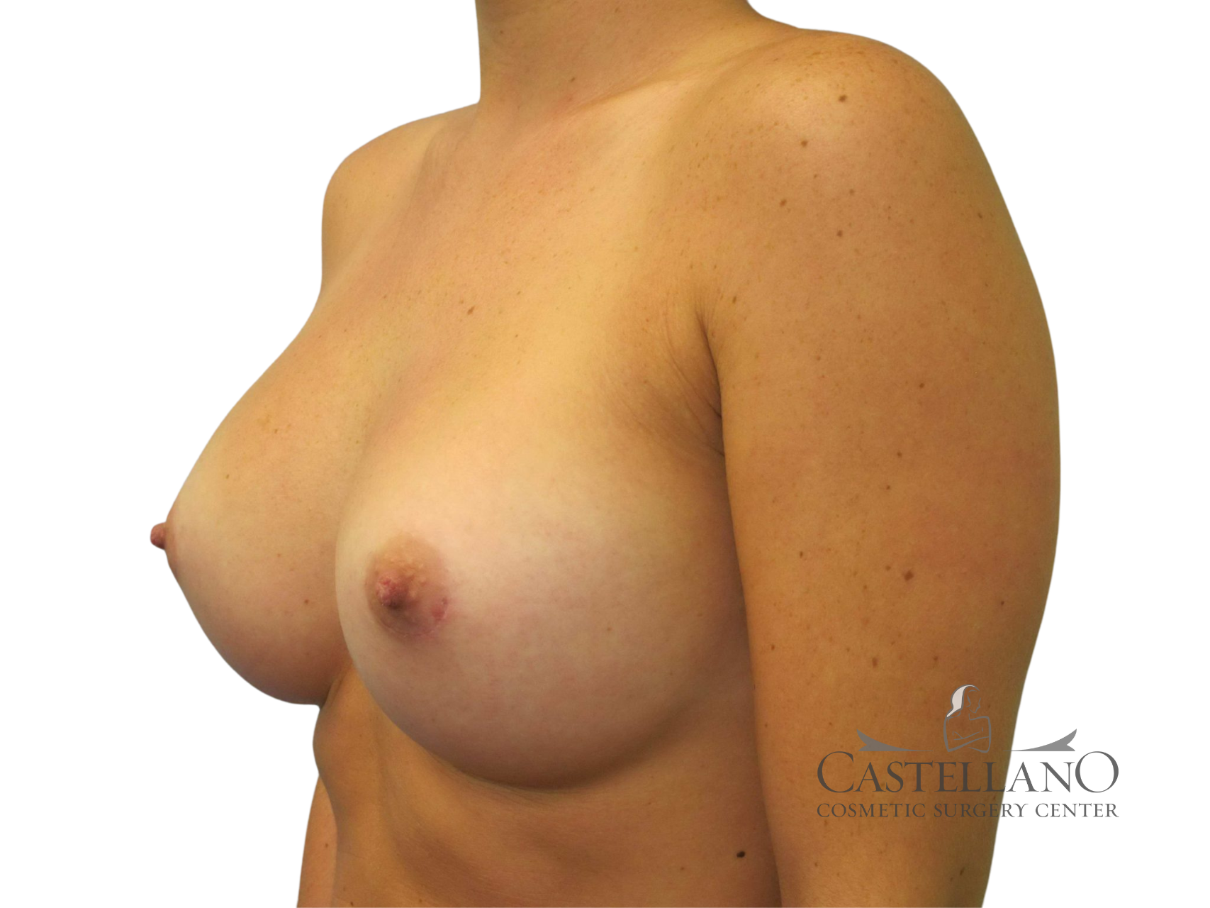 Breast Augmentation Patient Photo - Case 68 - after view-0