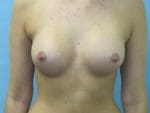 Breast Augmentation - Case 66 - After