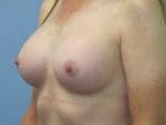 Breast Augmentation - Case 43 - After