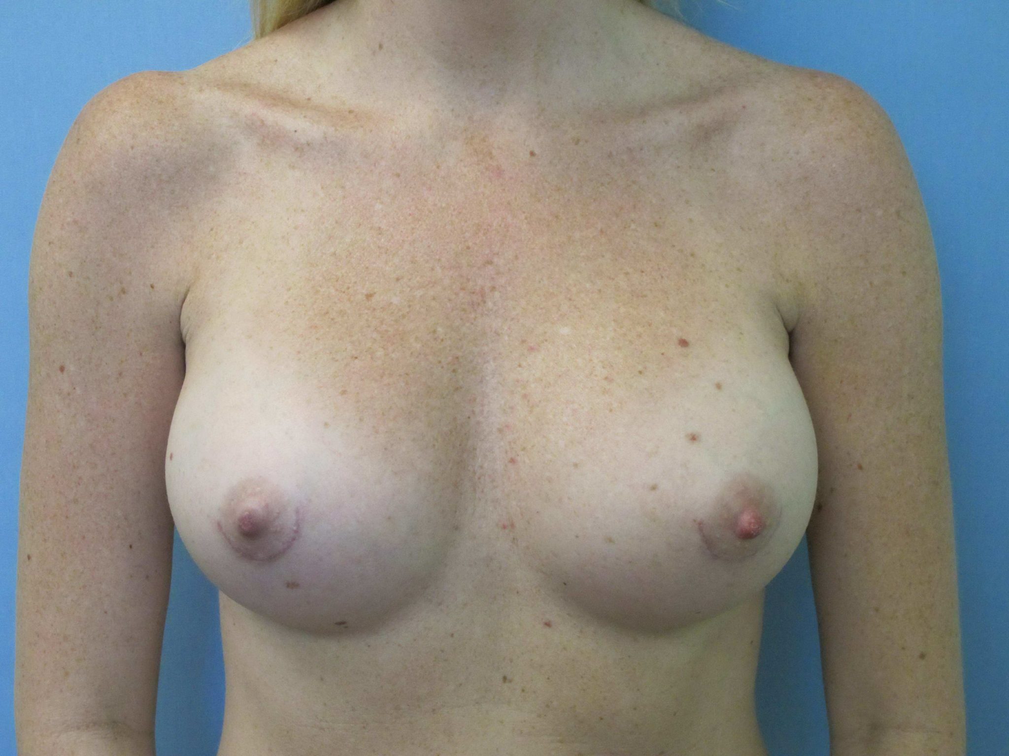 Breast Augmentation Patient Photo - Case 39 - after view-0