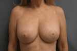 Breast Lift - Case 170 - After