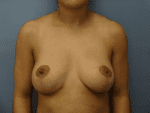Breast Lift - Case 169 - After