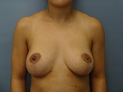 Breast Lift Patient Photo - Case 169 - after view-0