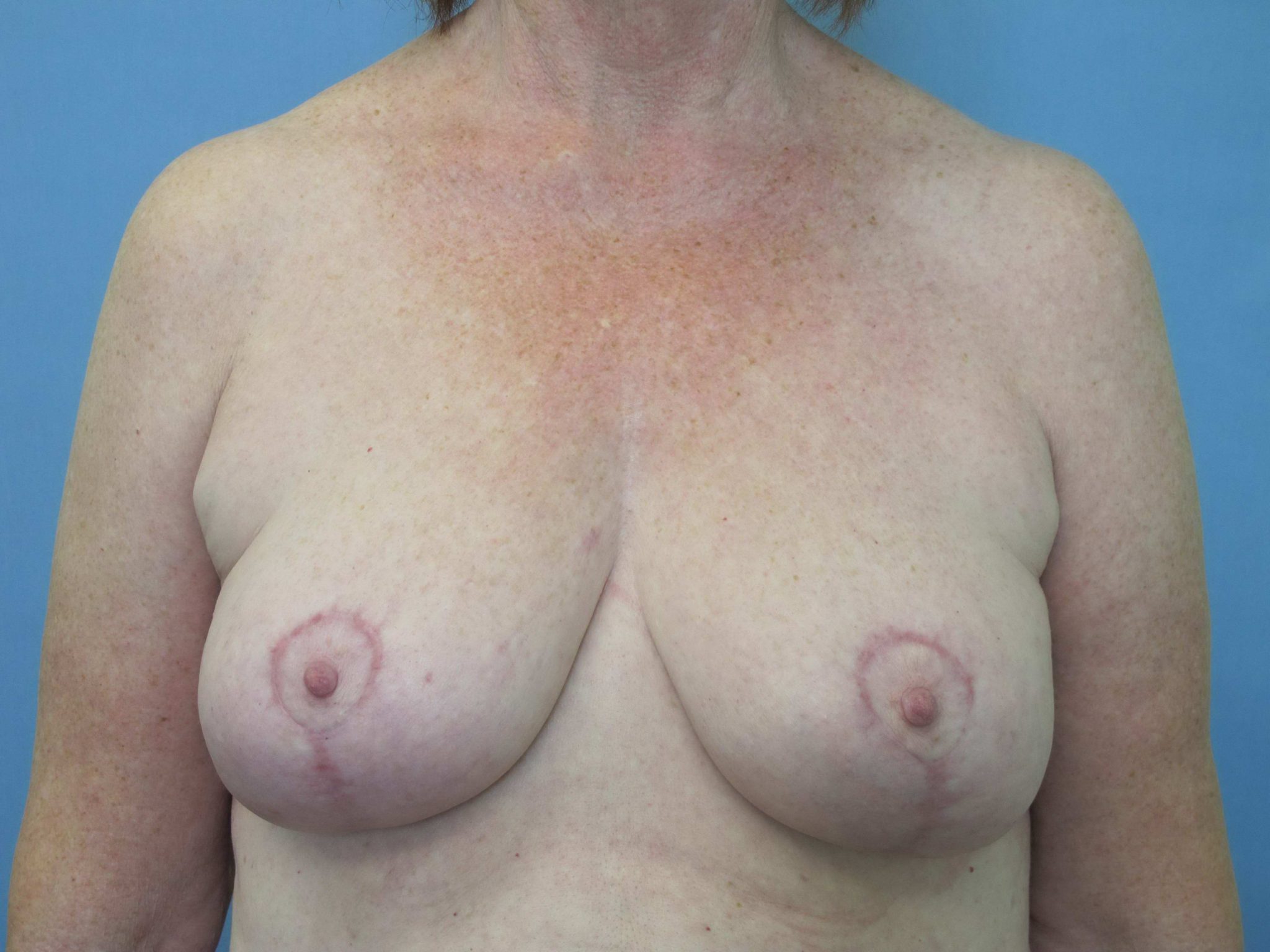 Breast Lift Patient Photo - Case 72 - after view