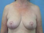 Breast Reduction - Case 72 - After
