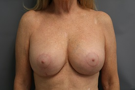 Breast Surgery Revision Patient Photo - Case 170 - after view-0