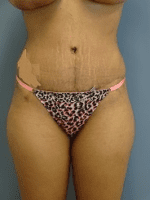 Tummy Tuck - Case 166 - After