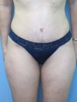 Tummy Tuck - Case 115 - After