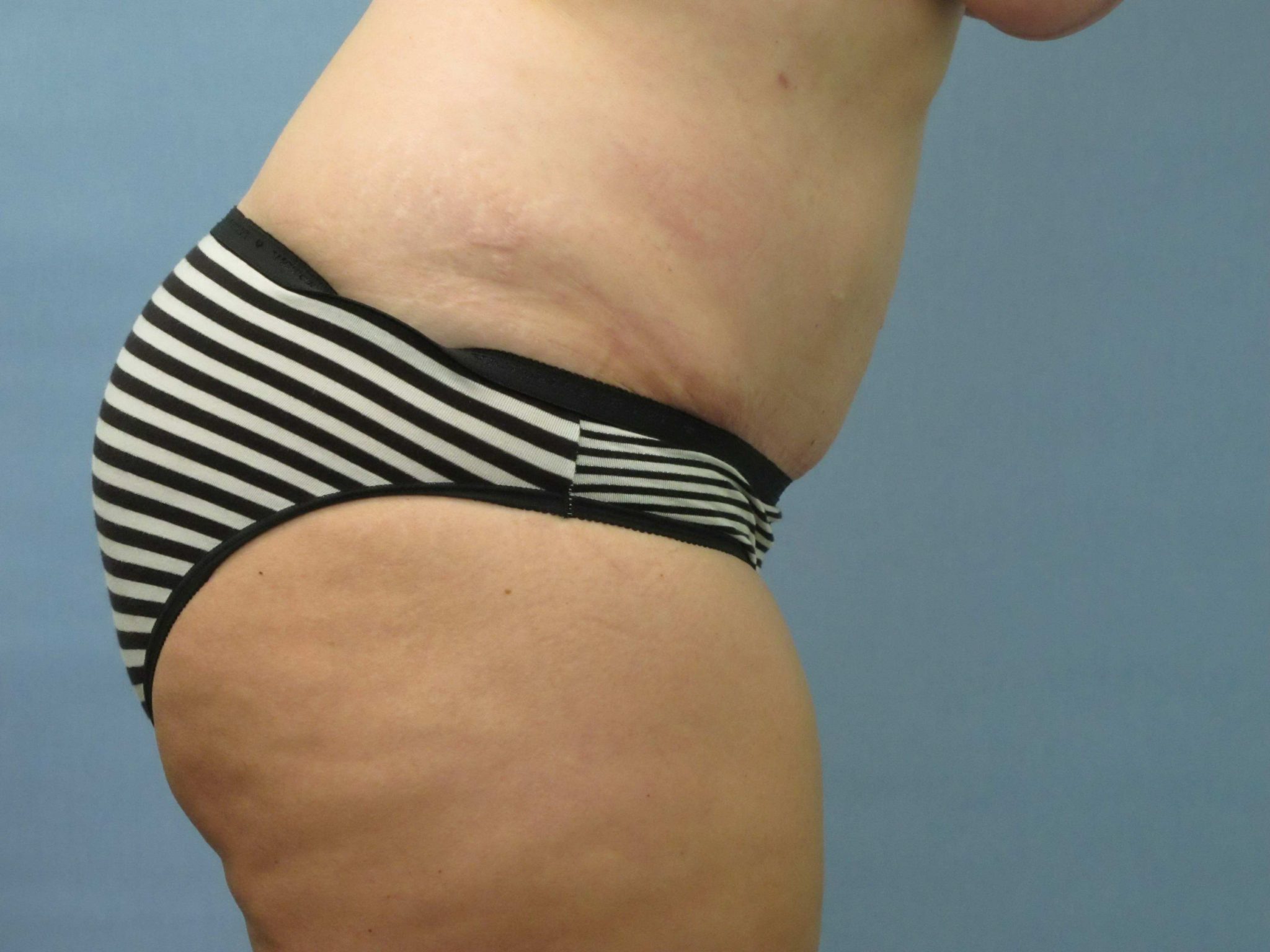 Tummy Tuck Patient Photo - Case 75 - after view-1