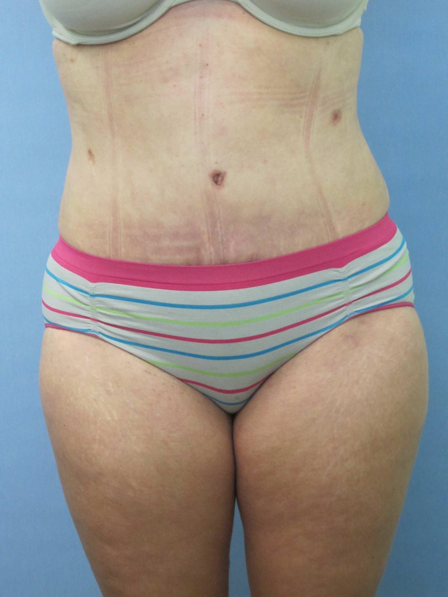 Avelar Tummy Tuck Patient Photo - Case 154 - after view