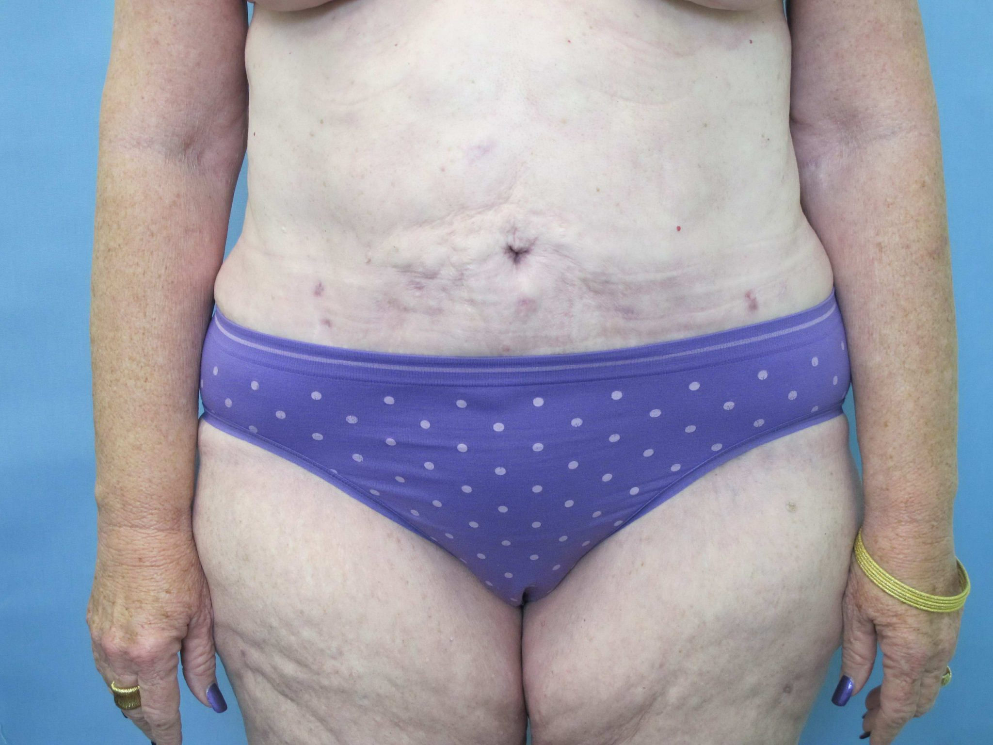 Tummy Tuck Patient Photo - Case 78 - after view