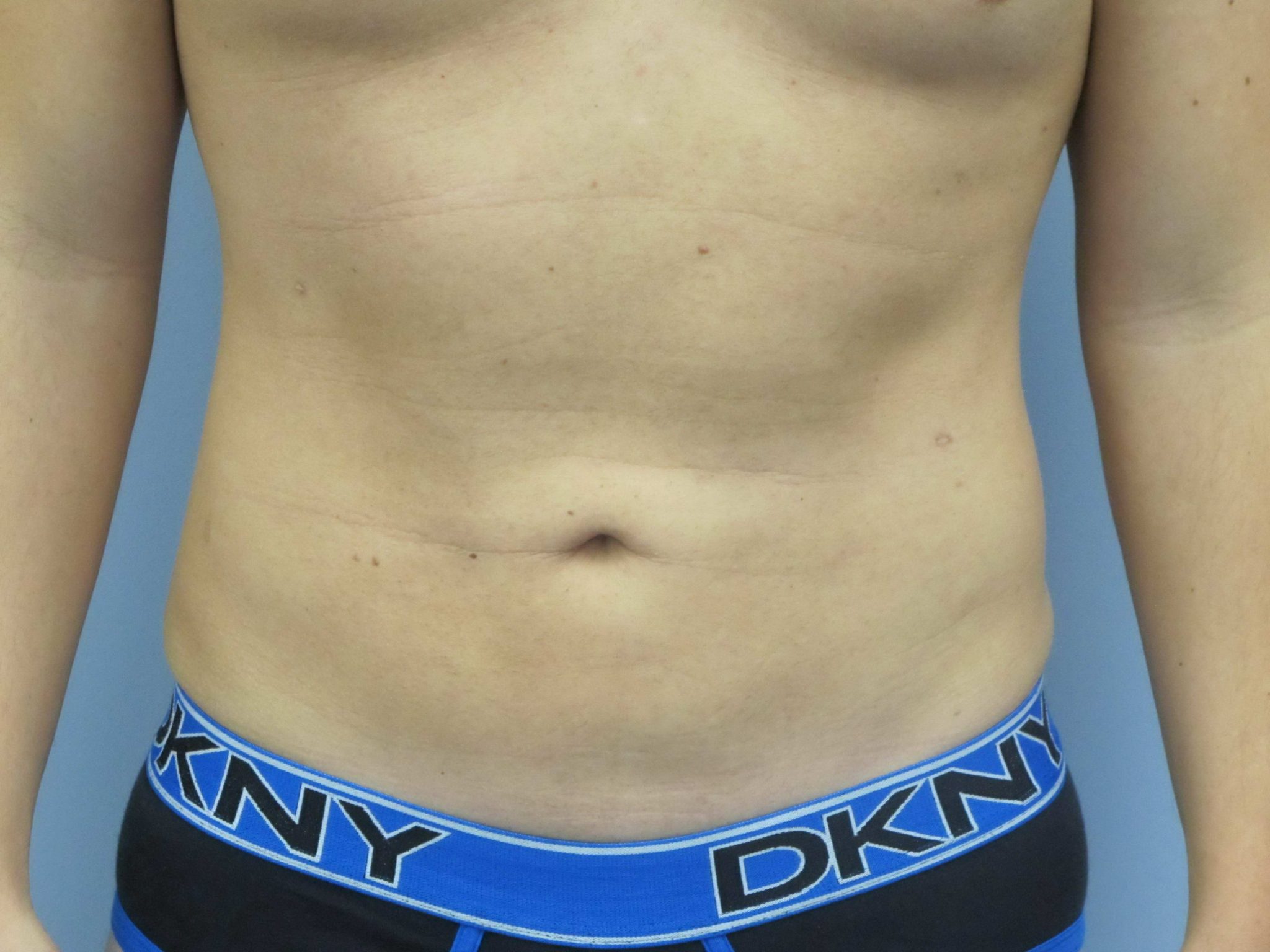 Liposuction Patient Photo - Case 118 - after view