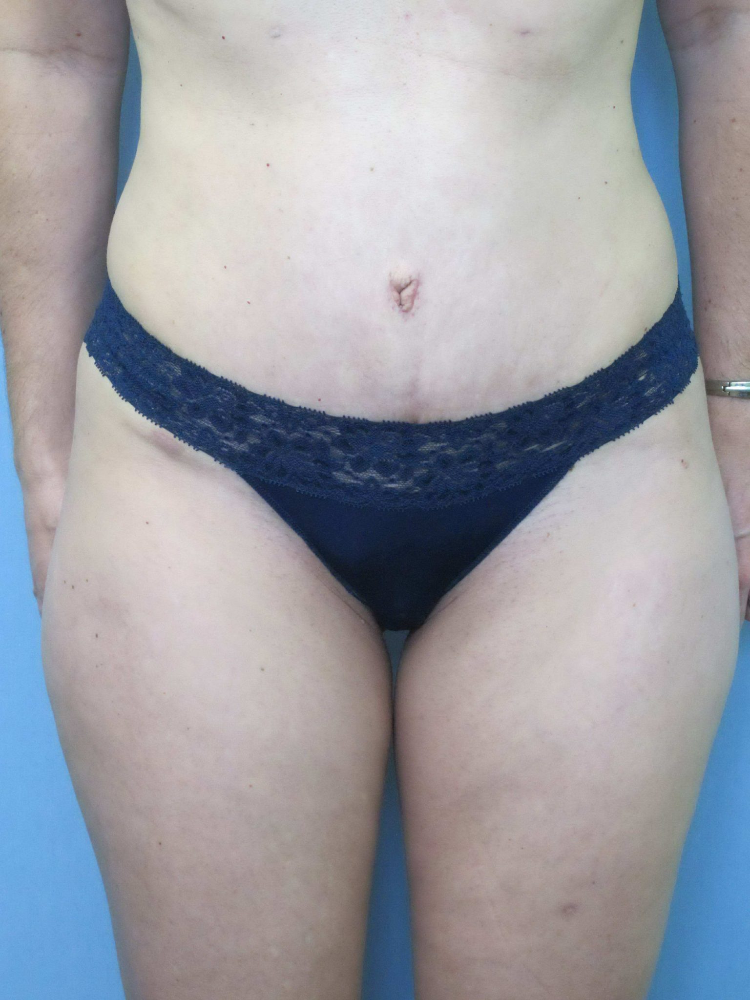 Liposuction Patient Photo - Case 115 - after view-0
