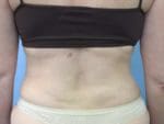 Liposuction - Case 83 - After