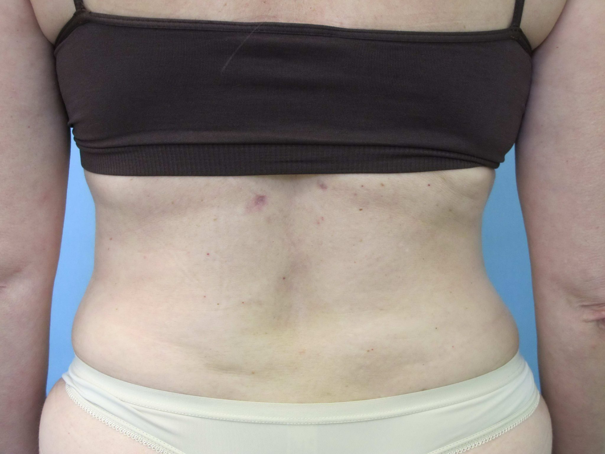 Liposuction Patient Photo - Case 83 - after view