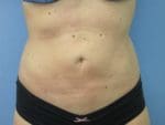 Liposuction - Case 81 - After