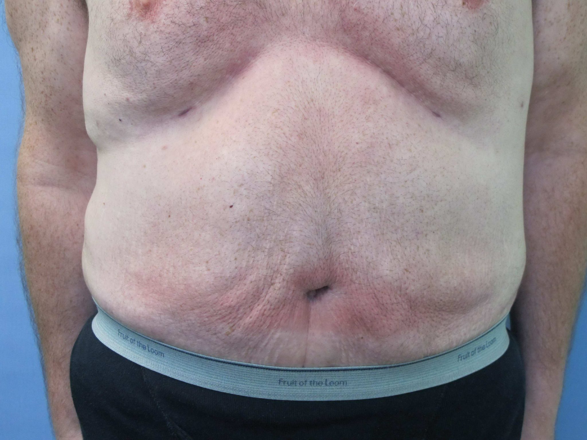 Liposuction Patient Photo - Case 76 - after view-0