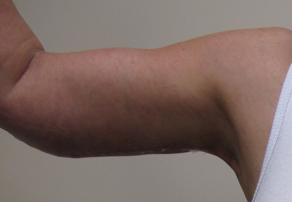 Arm Lift Patient Photo - Case 114 - after view-3