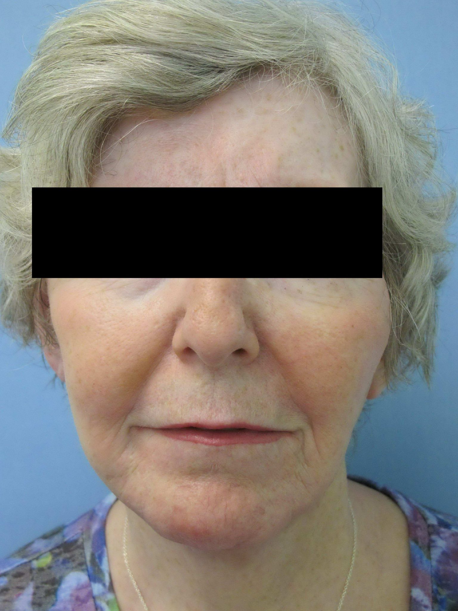 Facelift Patient Photo - Case 56 - after view