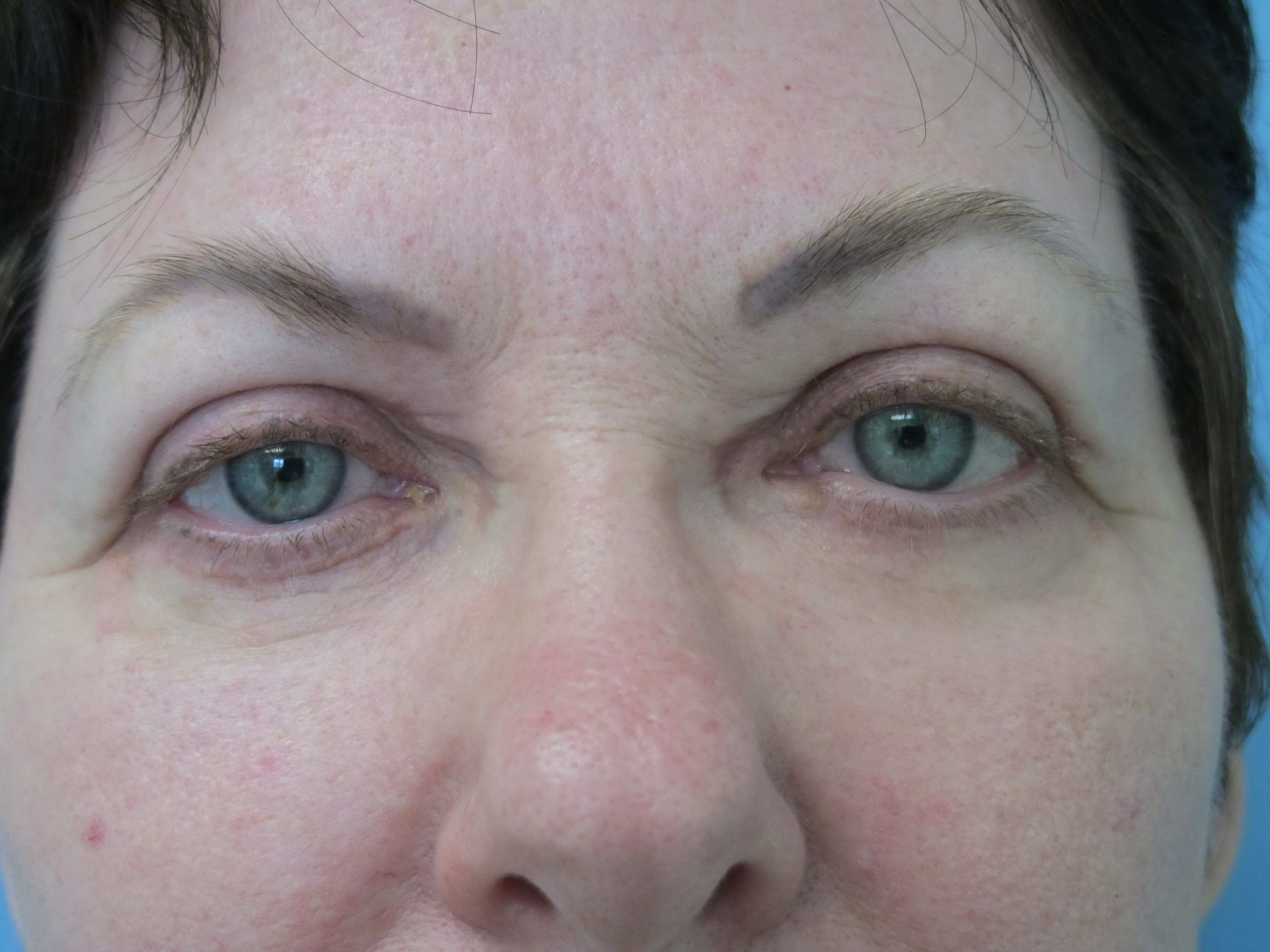 Eyelid Surgery Patient Photo - Case 121 - after view-0