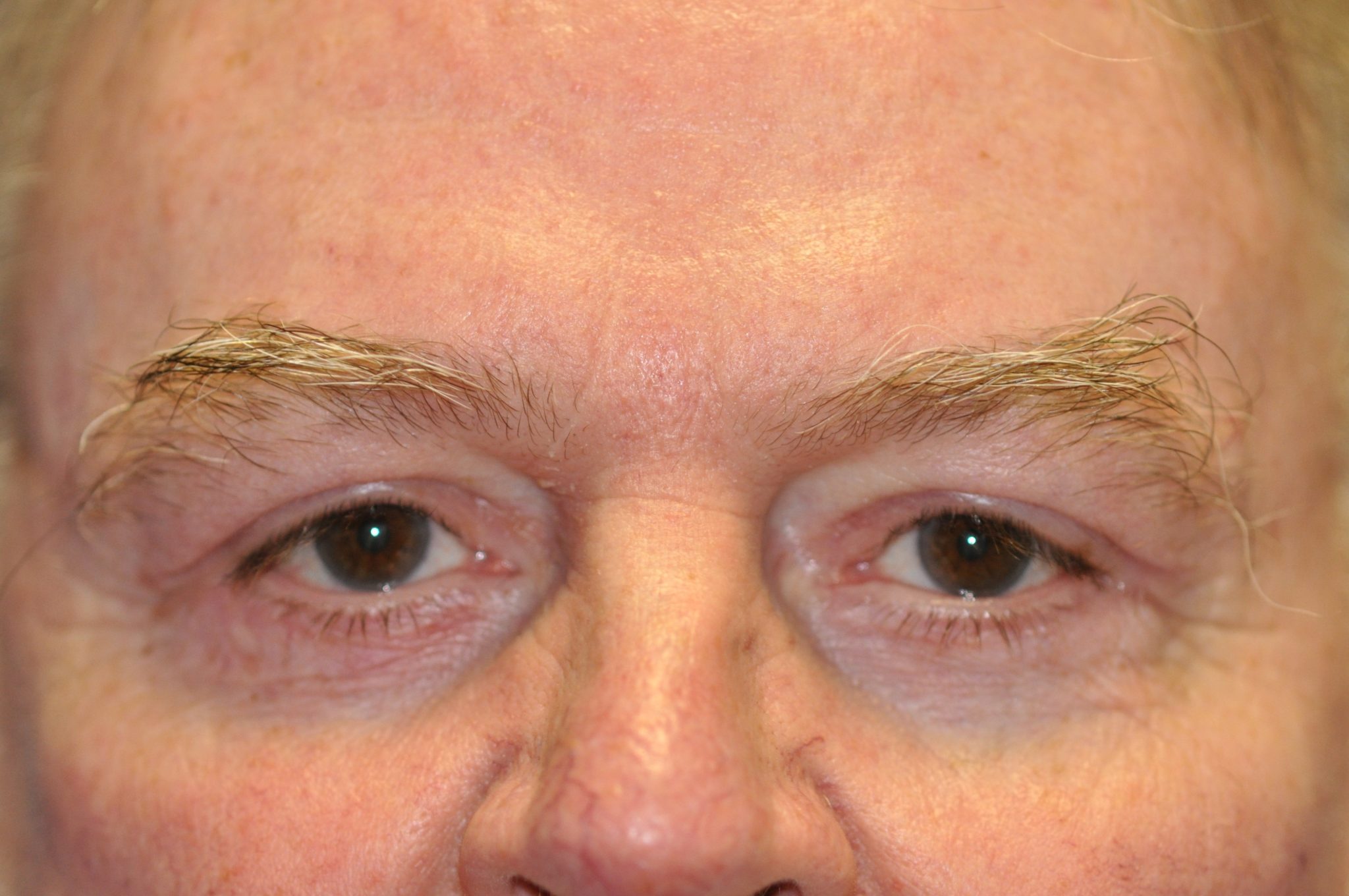 Eyelid Surgery Patient Photo - Case 108 - after view
