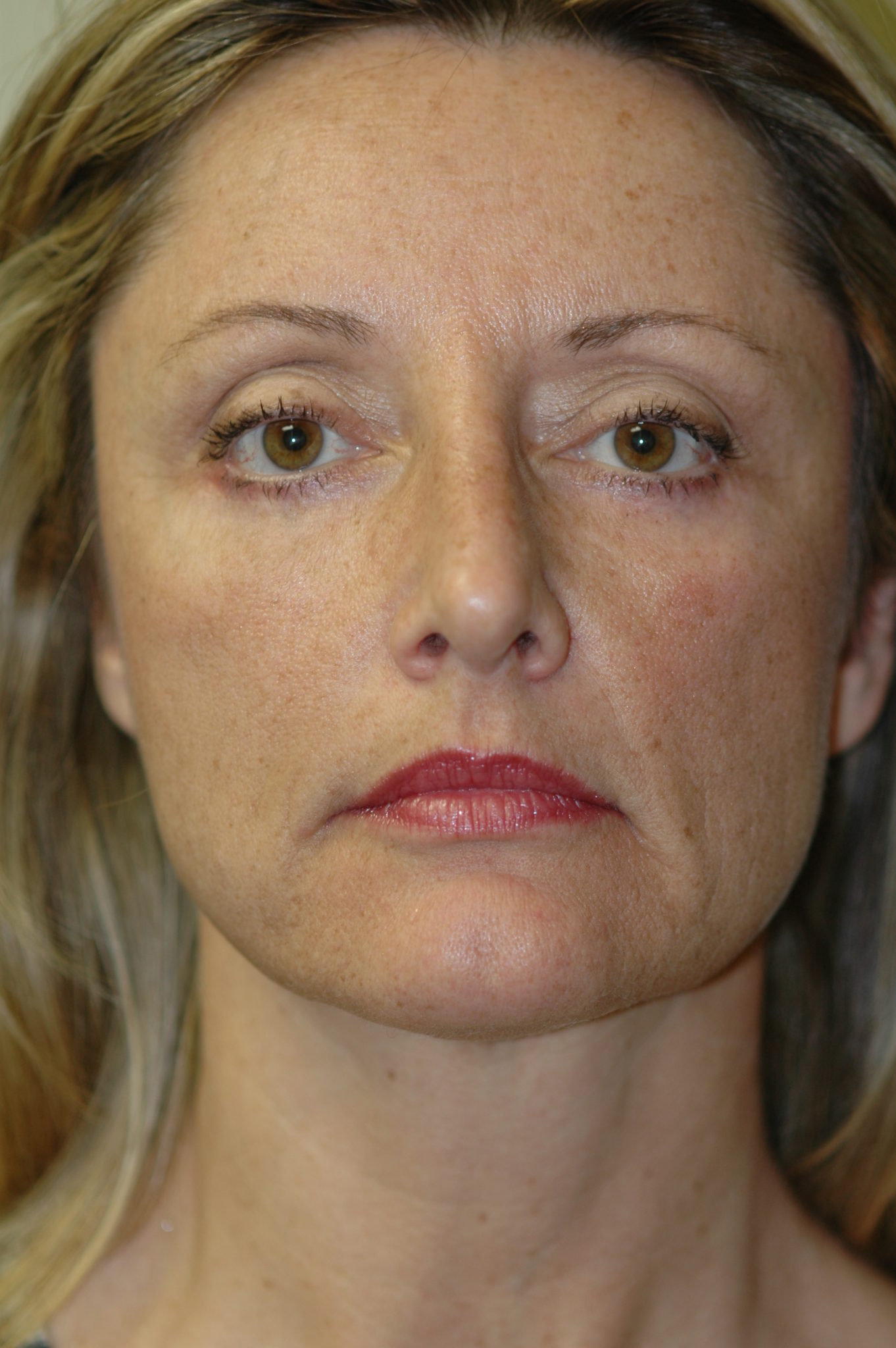 Eyelid Surgery Patient Photo - Case 104 - after view-0