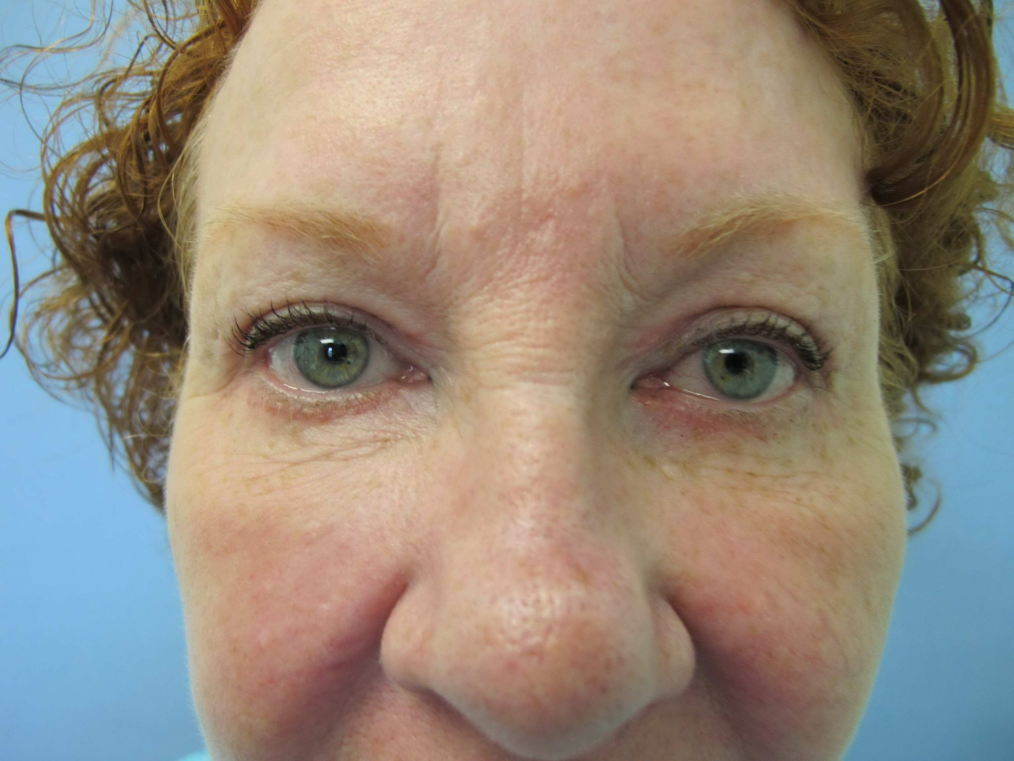 Eyelid Surgery Patient Photo - Case 53 - after view