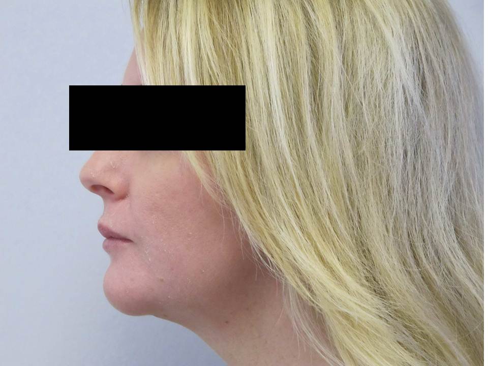 Chin/Cheek Implant Patient Photo - Case 57 - after view