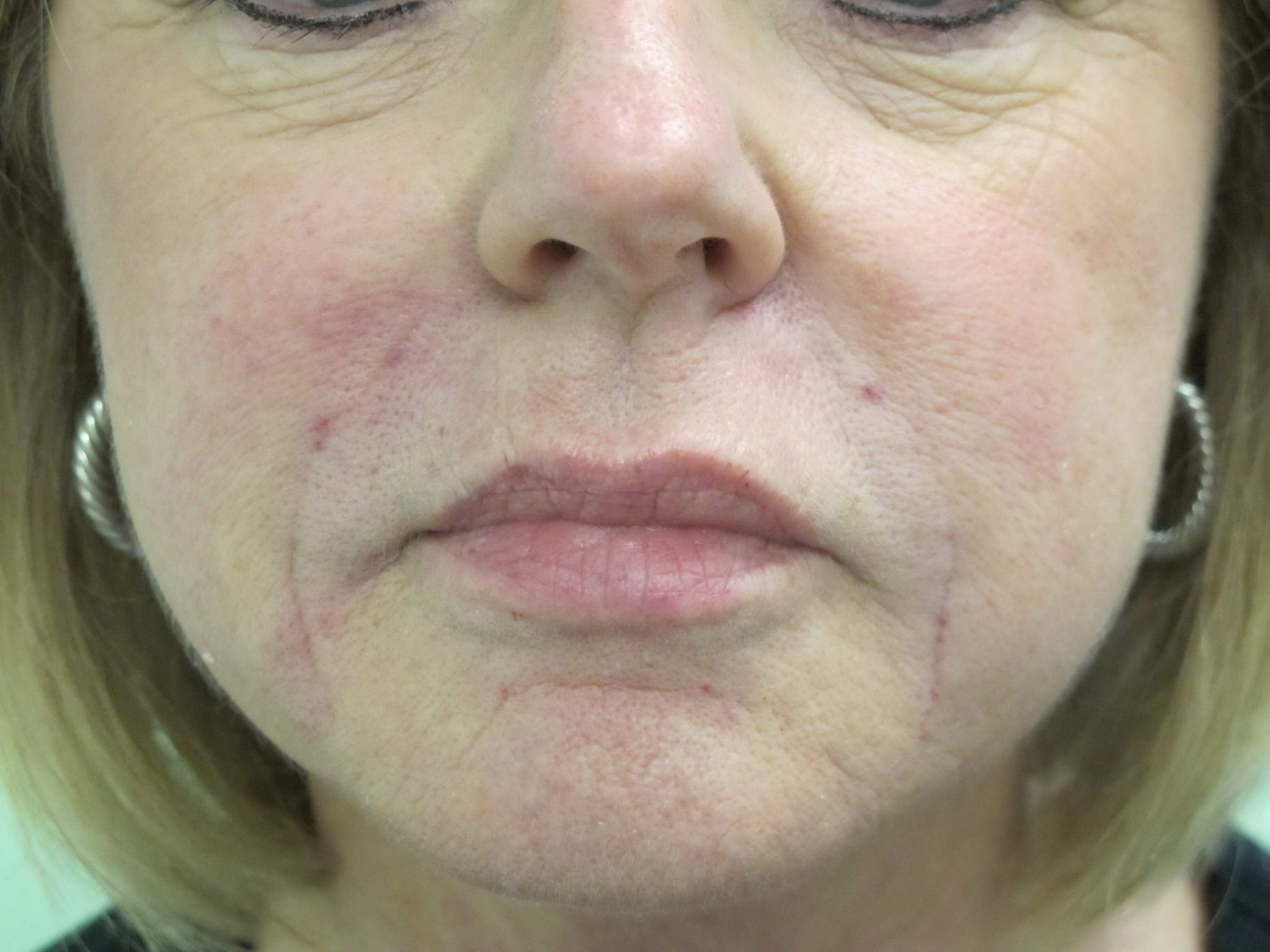 Injectable Fillers Patient Photo - Case 133 - after view-0