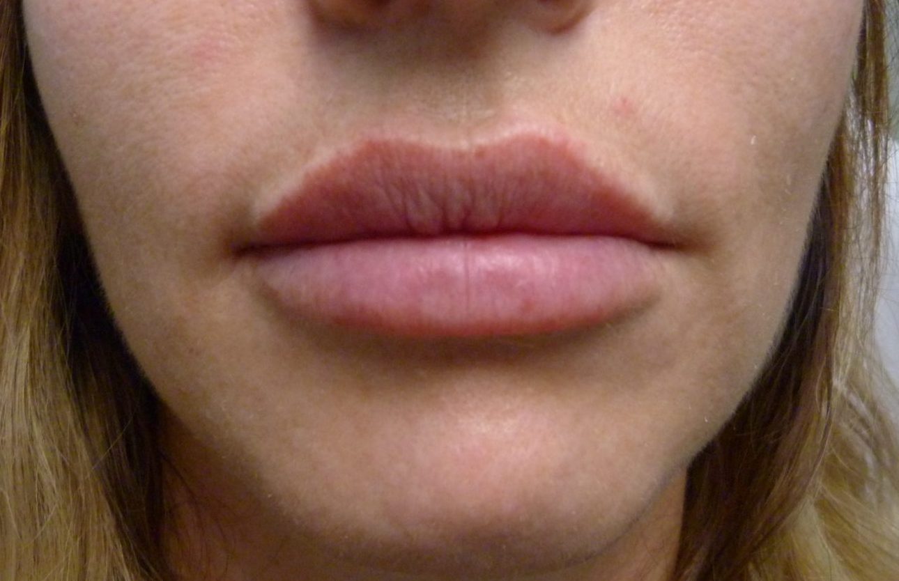 Lip Augmentation Patient Photo - Case 8220 - after view-0