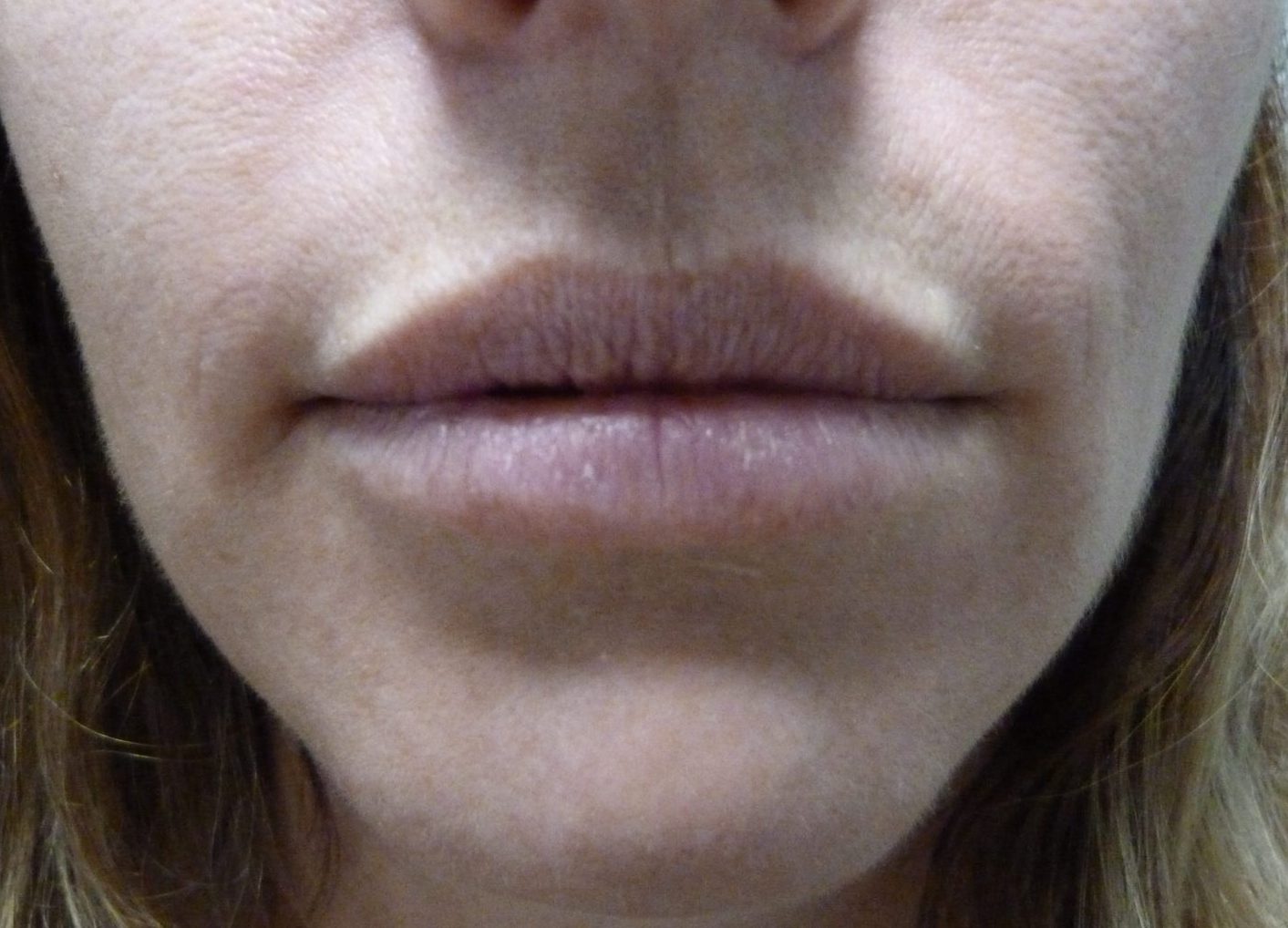 Lip Augmentation Patient Photo - Case 8220 - before view-0