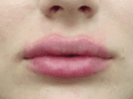 Lip Augmentation - Case 8288 - After