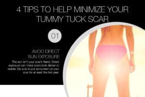 4 Tips to Help Minimize Your Tummy Tuck Scar [Infographic]