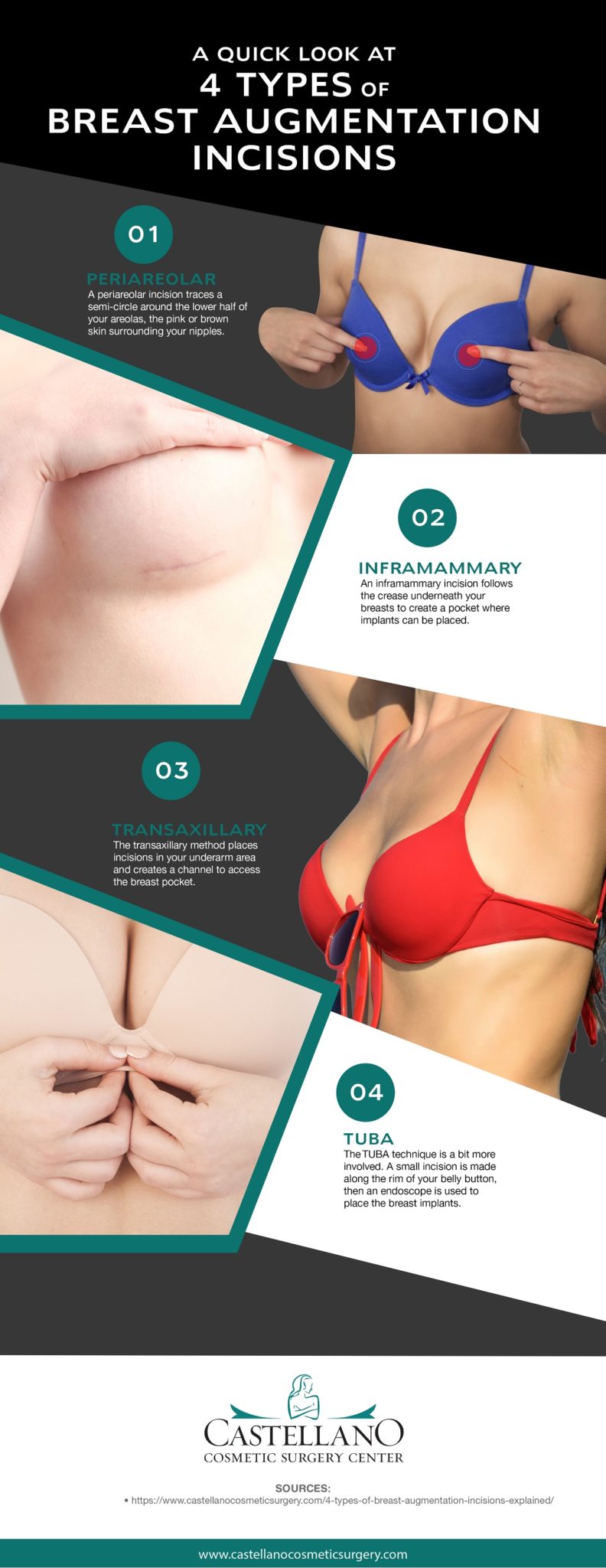 A Quick Look at 4 Types of Breast Augmentation Incisions [Infographic] img 1