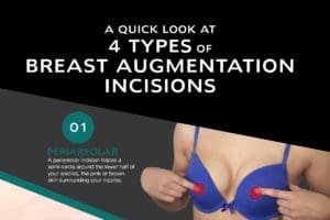A Quick Look at 4 Types of Breast Augmentation Incisions [Infographic]