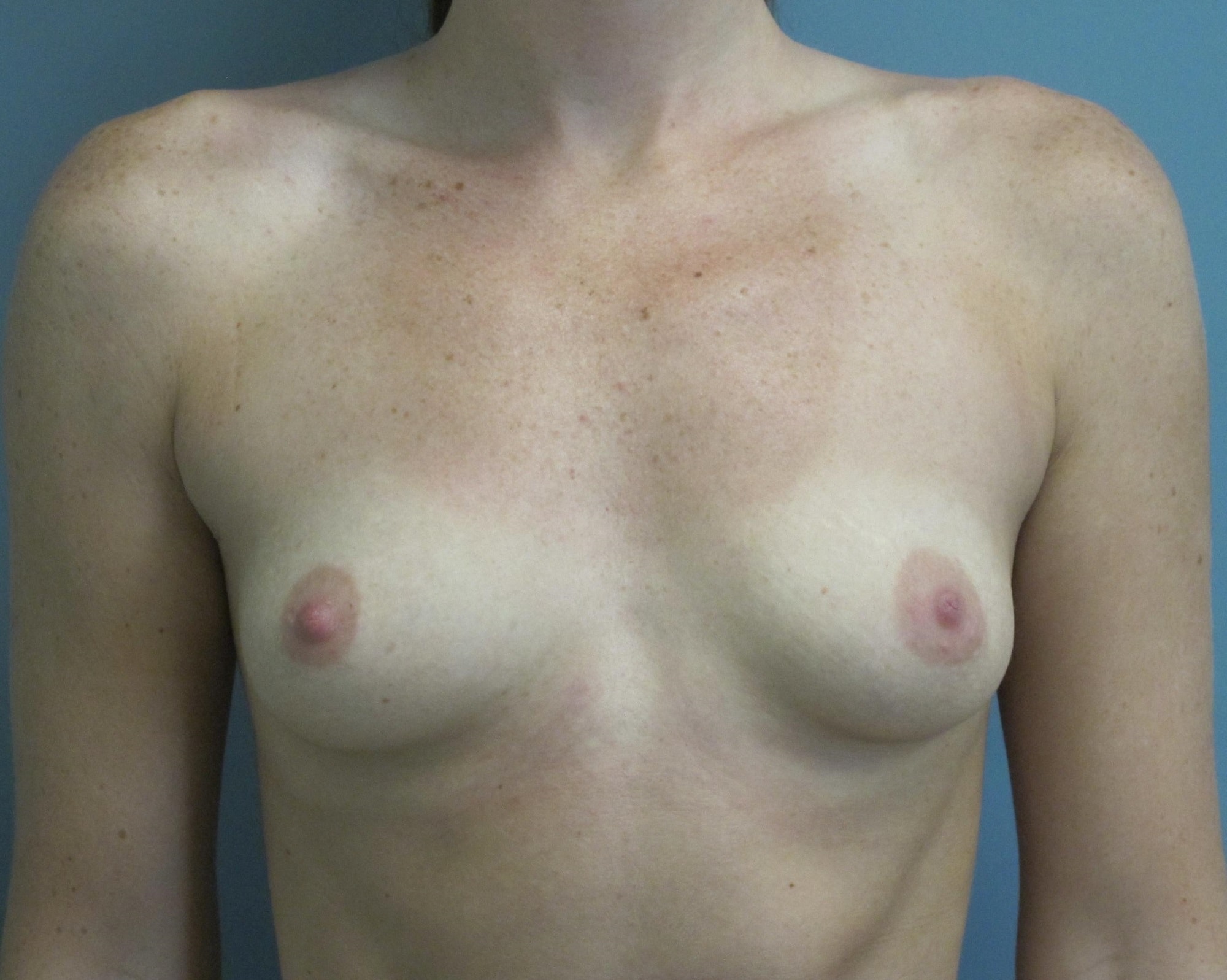 Breast Augmentation Patient Photo - Case 153 - before view-