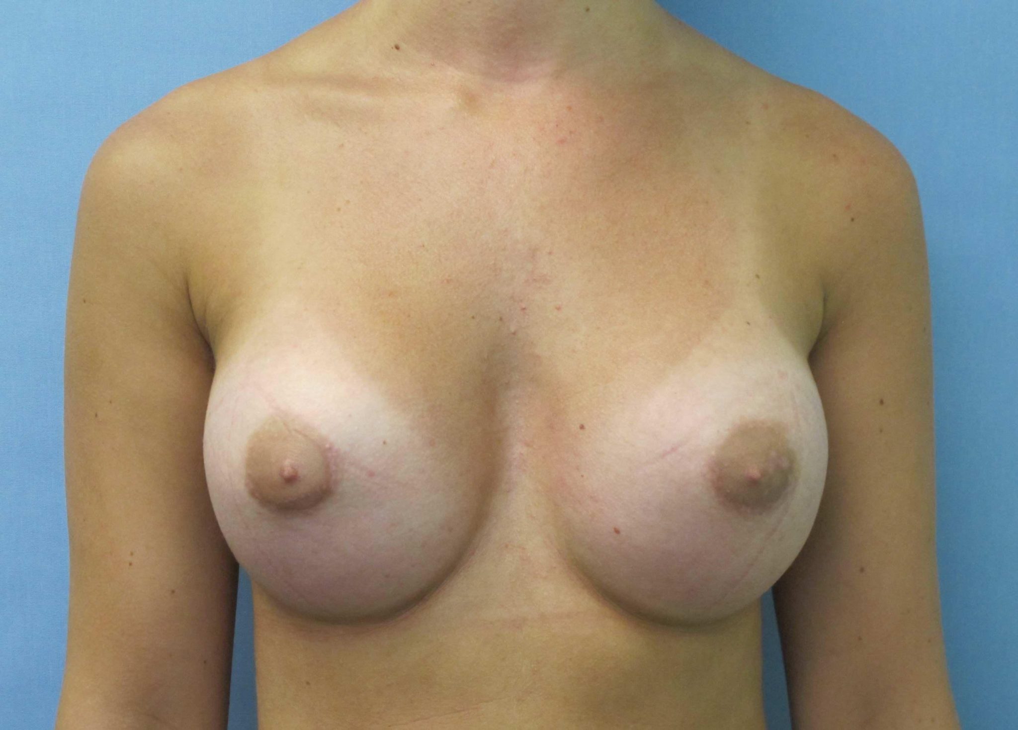 Breast Augmentation Patient Photo - Case 160 - after view-1