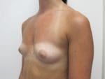 Breast Augmentation - Case 160 - Before