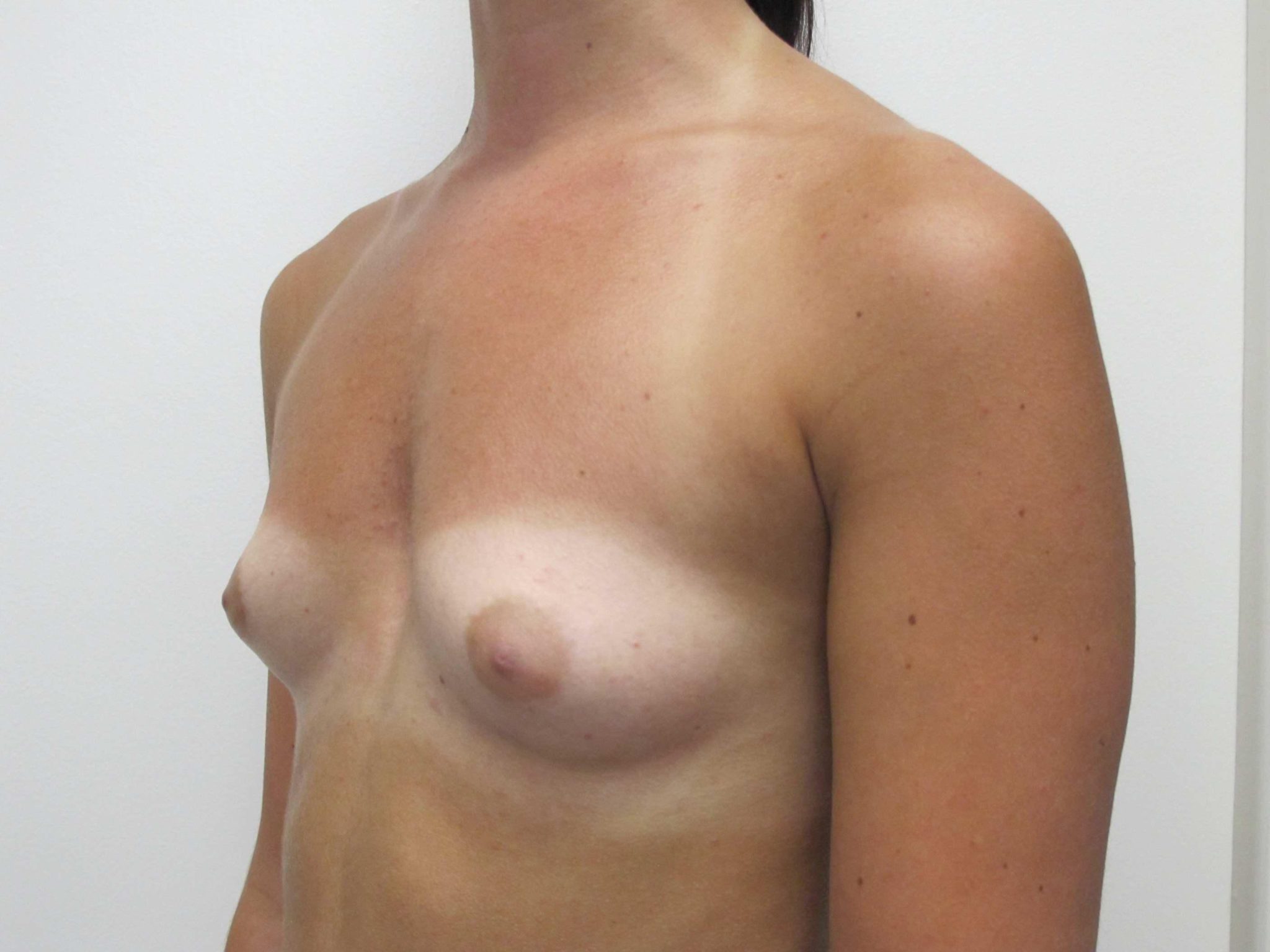 Breast Augmentation Patient Photo - Case 160 - before view-