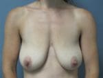 Breast Lift - Case 157 - Before