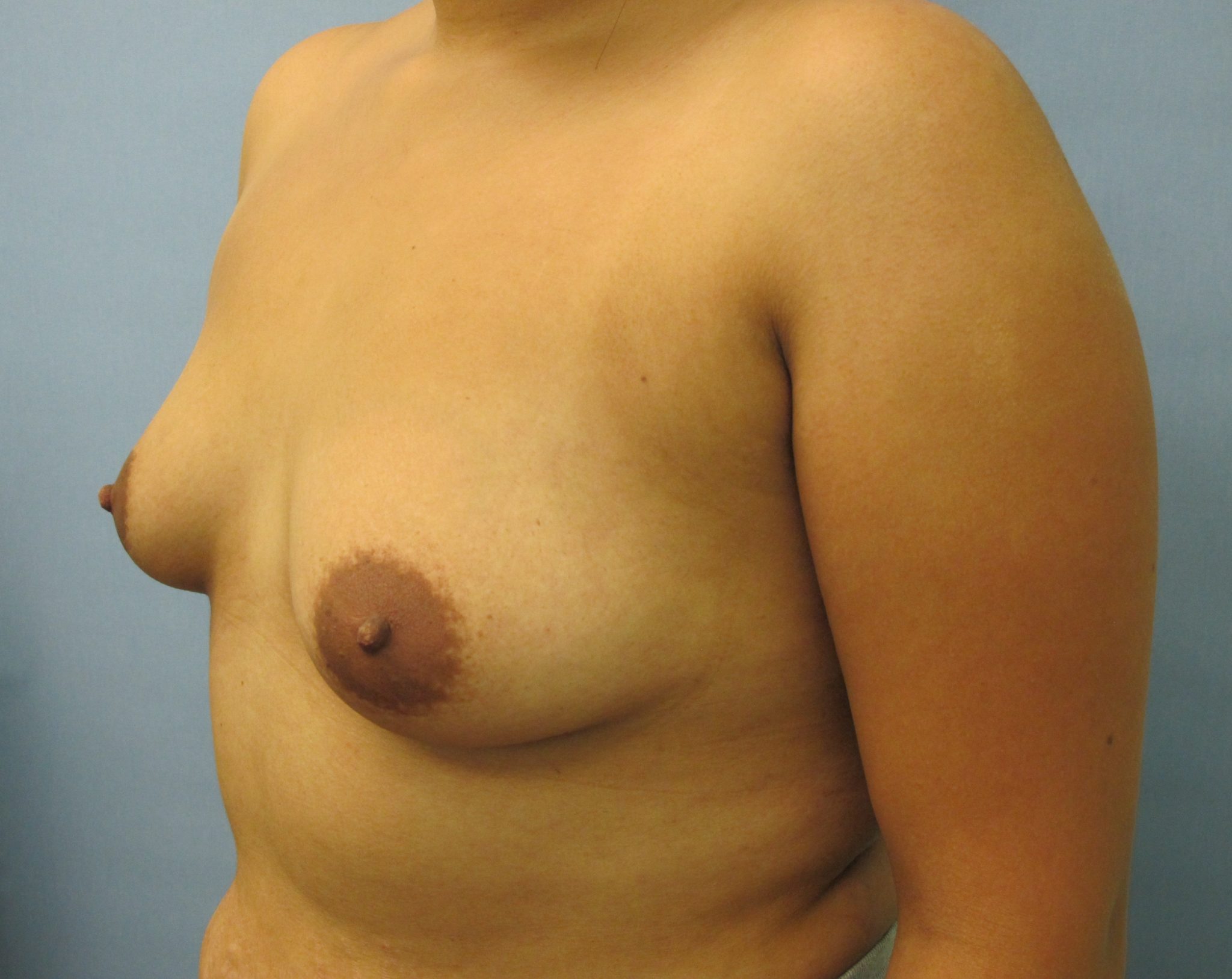 Breast Augmentation Patient Photo - Case 38 - before view-1