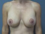 Breast Lift - Case 157 - After