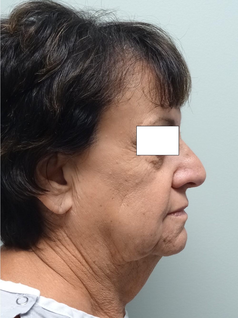 Facelift Patient Photo - Case 162 - before view-0