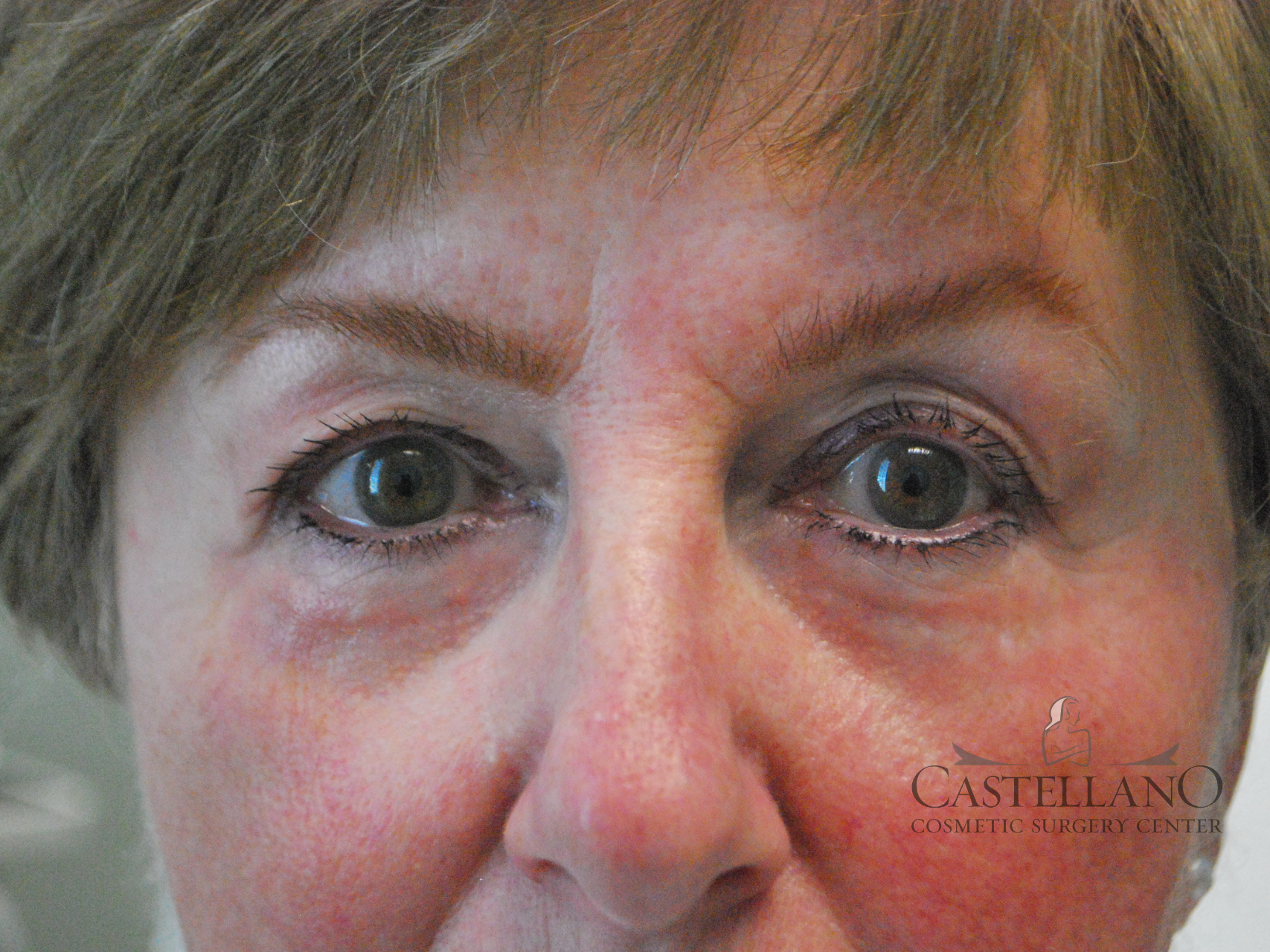 Laser Treatments Patient Photo - Case 8618 - after view-0