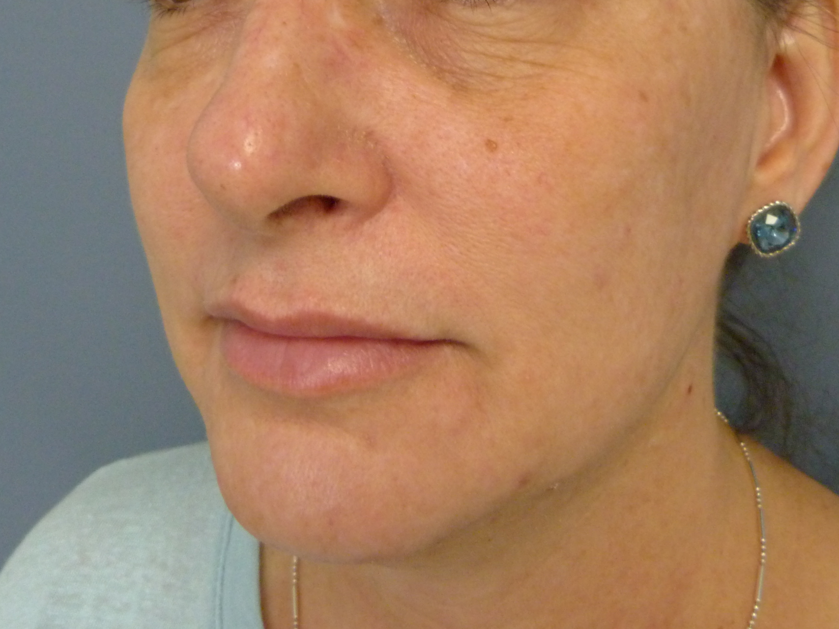 Injectable Fillers Patient Photo - Case 8626 - after view-0