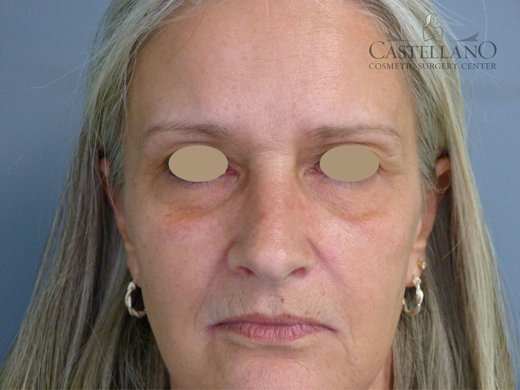 Injectable Fillers Patient Photo - Case 8630 - before view-0