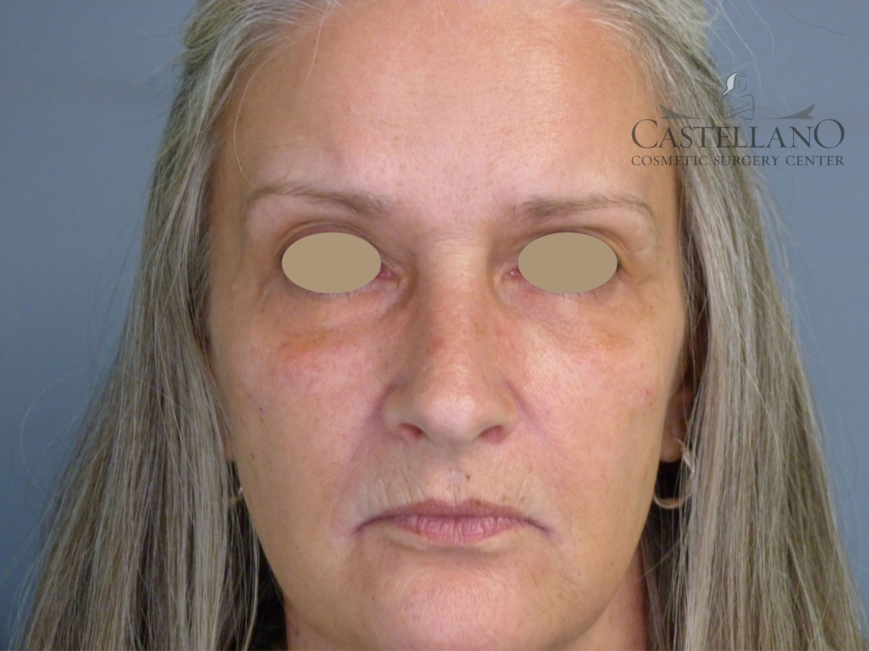 Injectable Fillers Patient Photo - Case 8630 - after view