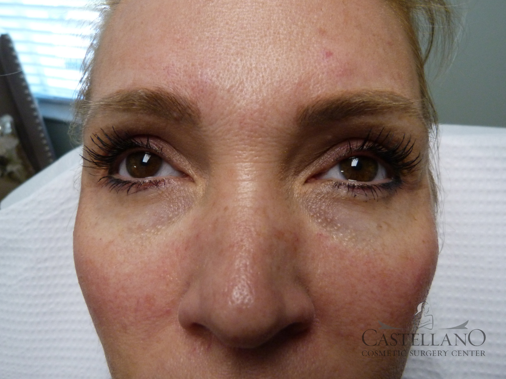 Injectable Fillers Patient Photo - Case 8636 - before view-