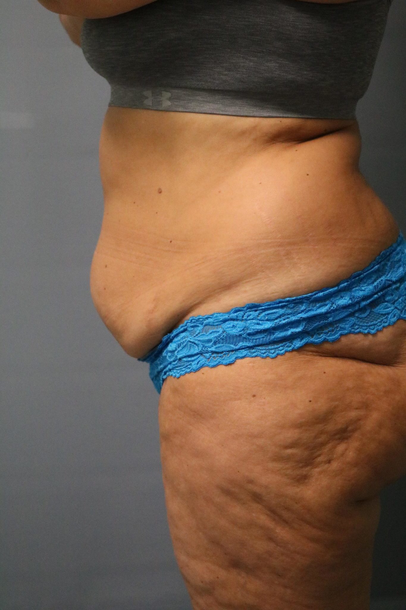 Tummy Tuck Patient Photo - Case 9234 - before view-1