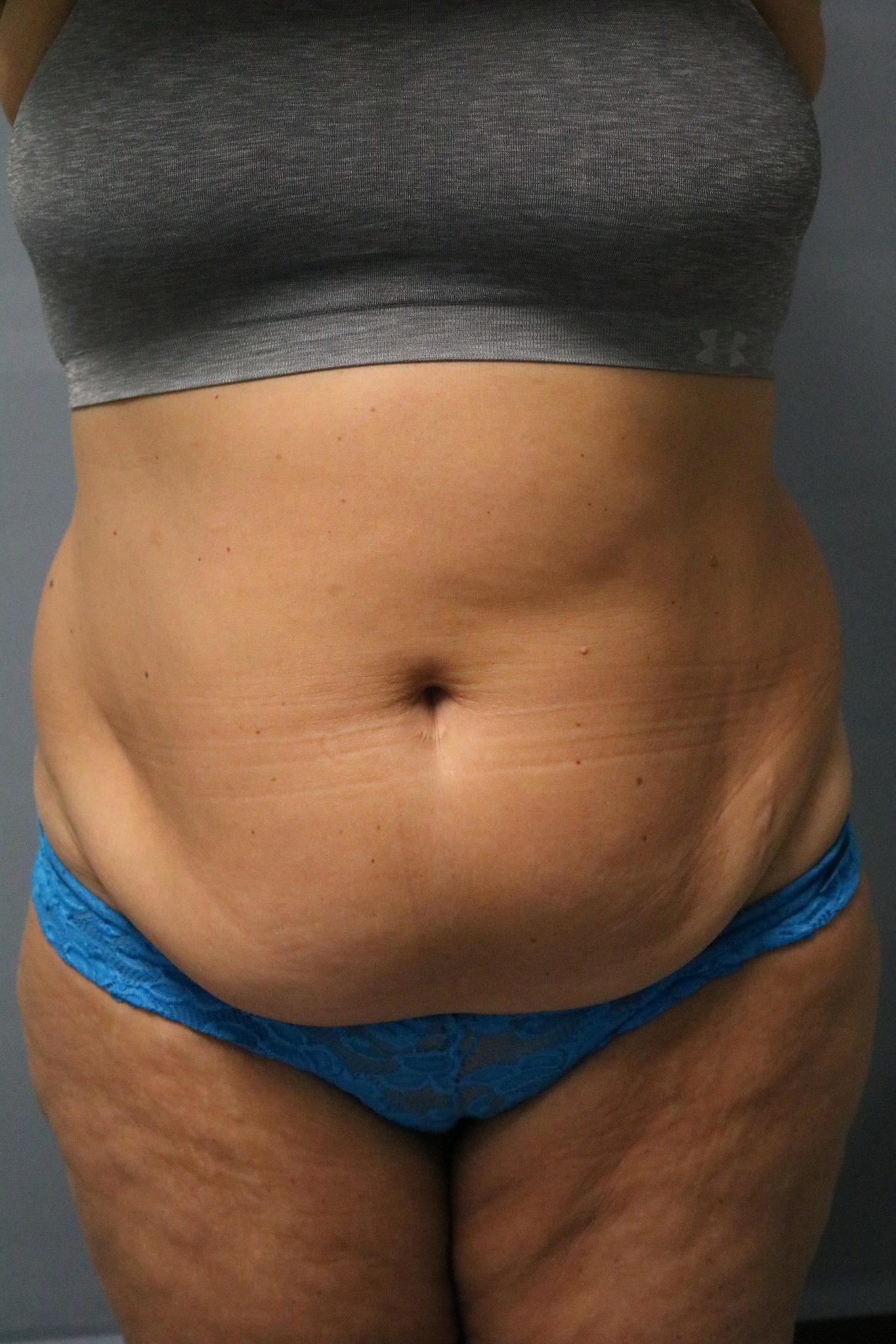 Avelar Tummy Tuck Patient Photo - Case 9234 - before view-0